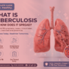 Tuberculosis